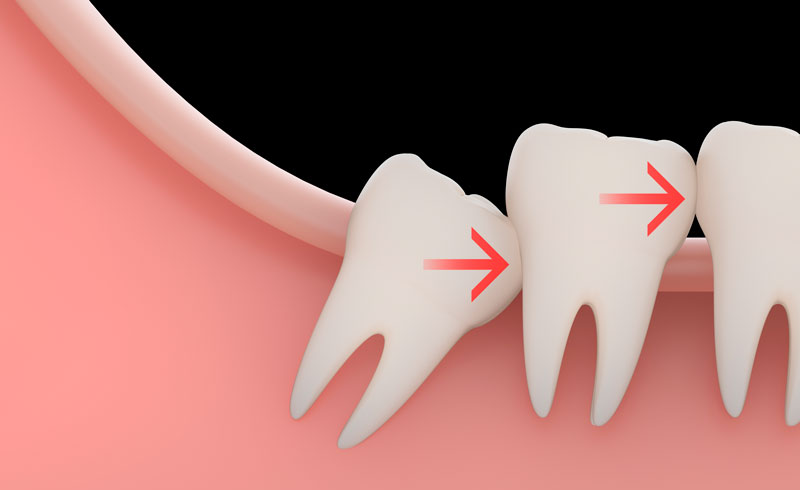 Wisdom Teeth