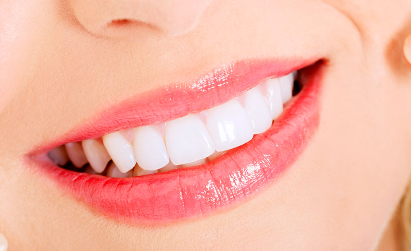 Dental Crowns vs. Porcelain Veneers