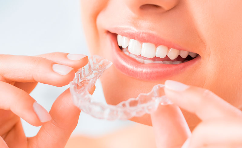 What are Clear Braces?