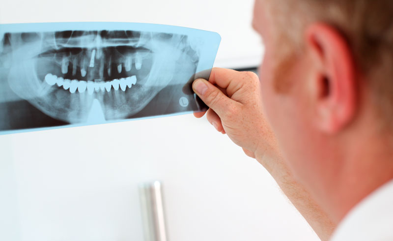 Repairing Broken or Fractured Teeth