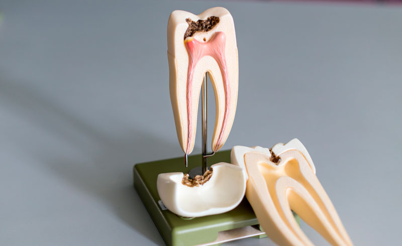 Root Canal