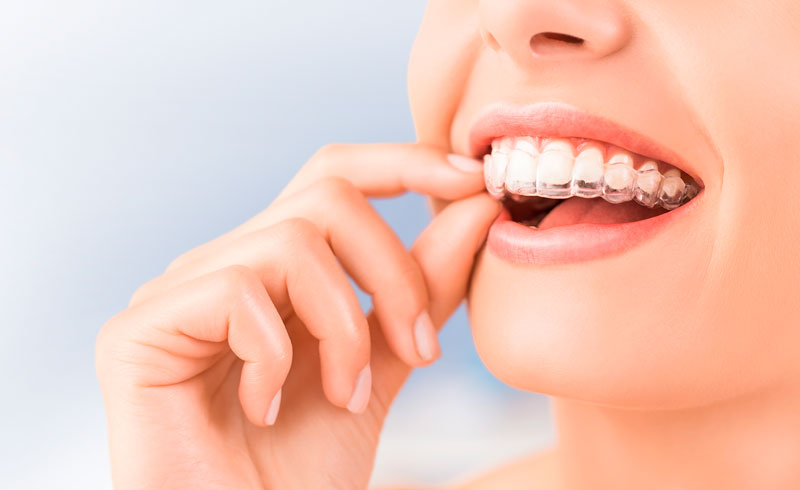 Correcting Gap Teeth with Invisalign®