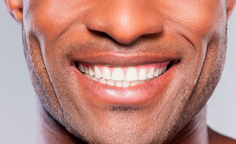 Are You a Candidate for a Smile Makeover?