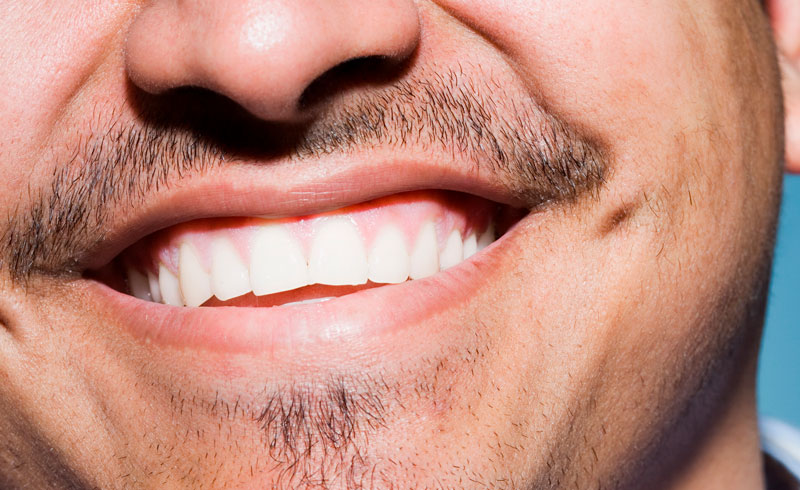 What Are the Advantages of Invisalign®?