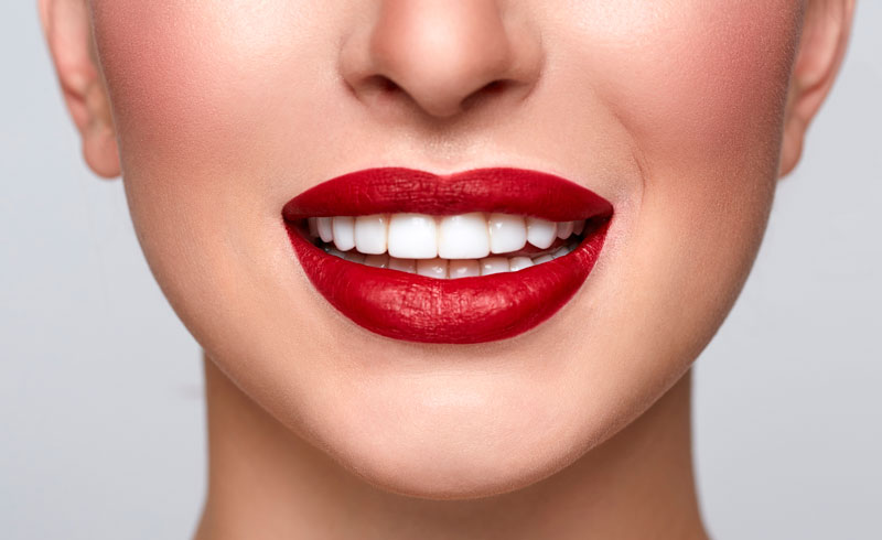 Can Porcelain Veneers be Whitened?