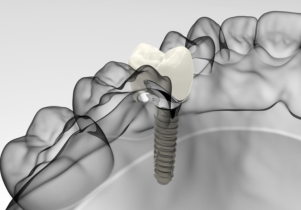 Bridging the Gap Dental Implants Molson Park Dental