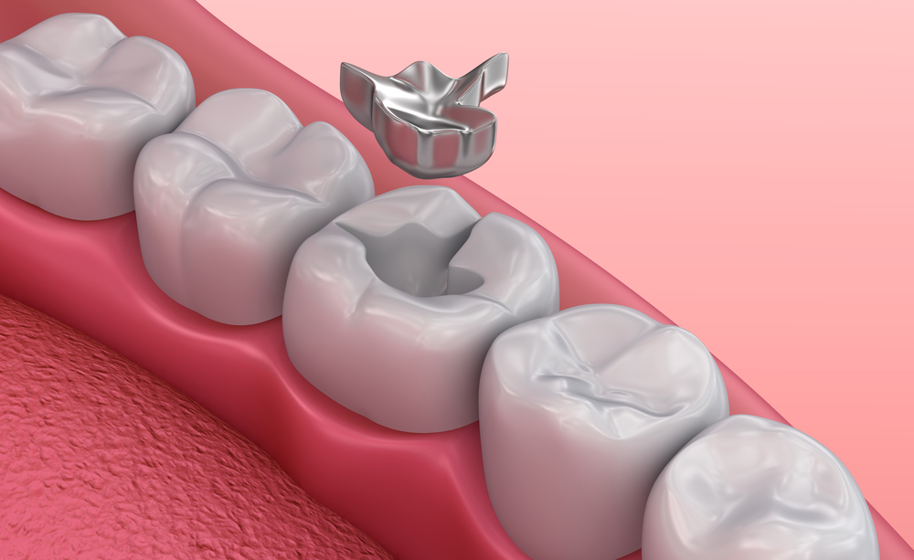 How Can Skin Metal Allergies Be Related To Dental Metal Allergies?