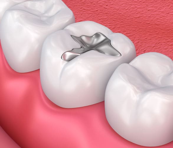 metalfillings Molson Park Dental