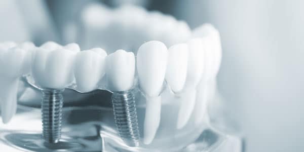 Molson-Park-Dental-Implants-Toronto